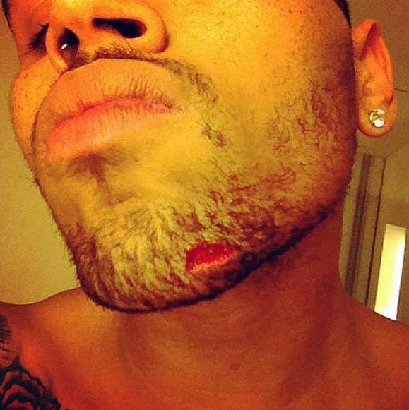 Chris Brown machucado por causa do Drake