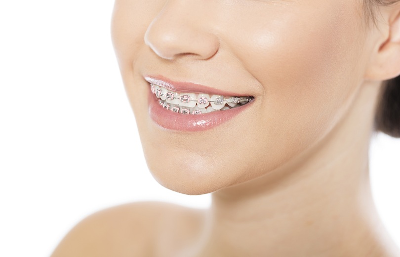 Garota sorrindo com aparelho fixo nos dentes