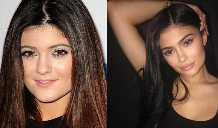 Kylie Jenner Antes E Depois De Corpo