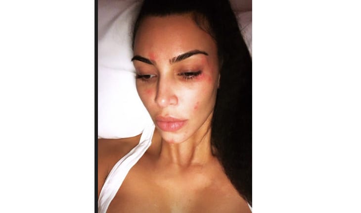 doença de Kim Kardashian