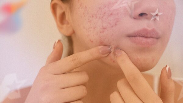 Acne na adolescência: o que é mito, o que é verdade e como tratar sem prejudicar a pele